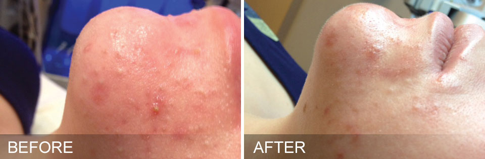 HydraFacial - Before & After for Oily Congested Skin